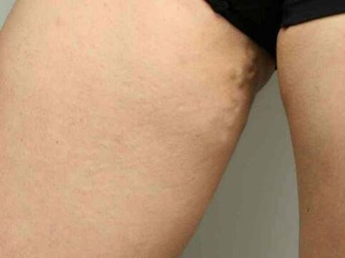 κιρσοί της λεκάνης κατά τη διάρκεια της εγκυμοσύνης